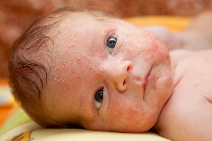 Khi trẻ bị rôm sảy, các nốt mẩn đỏ có thể hình thành đầu trắng và vỡ nước