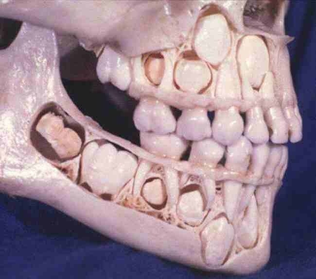 
Có lẽ bạn cũng không mấy để ý về cơ chế mọc răng của mình đâu nhỉ? Ảnh trên là mô hình xương của một đứa trẻ đã mọc hoàn chỉnh răng sữa. Răng vĩnh viễn vẫn đang nằm ở dưới, chờ thời cơ "nổi dậy". Và bạn có thấy lấp ló ở góc trong cùng kia không, hung thần răng khôn đấy.