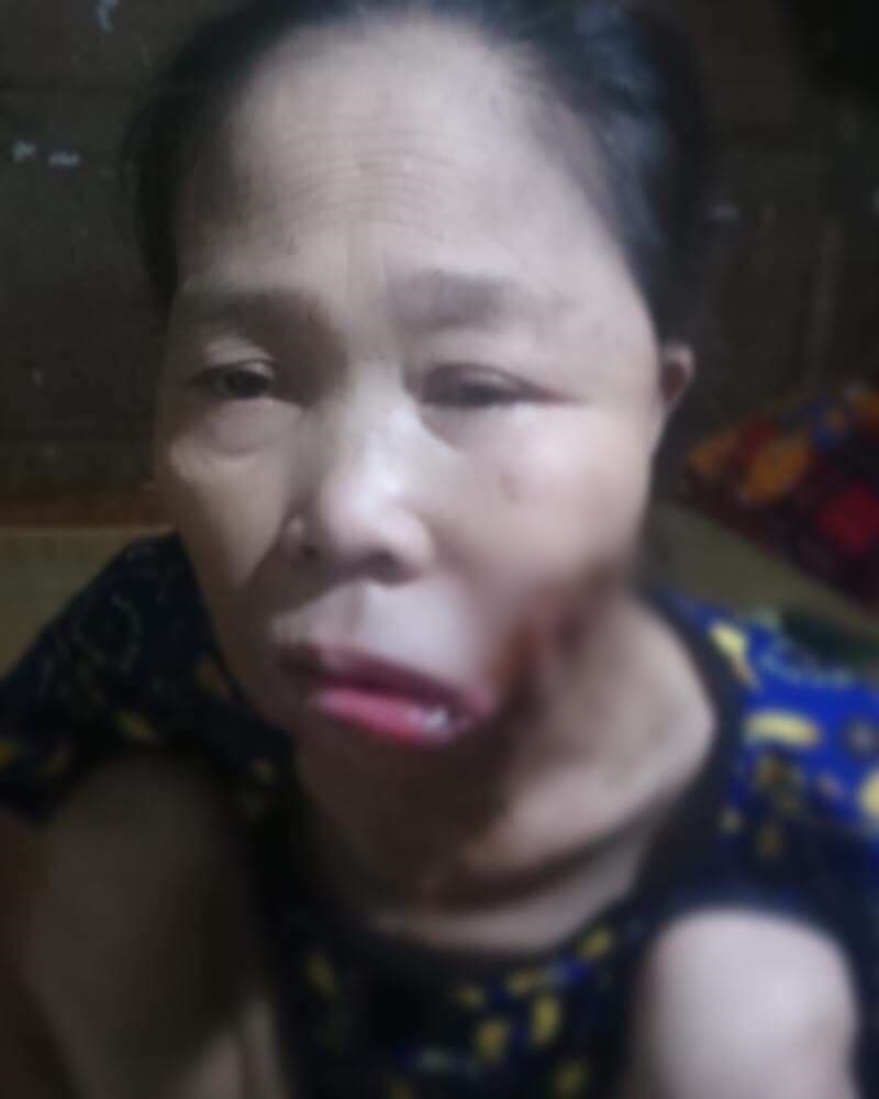 Khuôn mặt chị Nhung bị lở loét, biến dạng khi mắc căn bệnh lạ