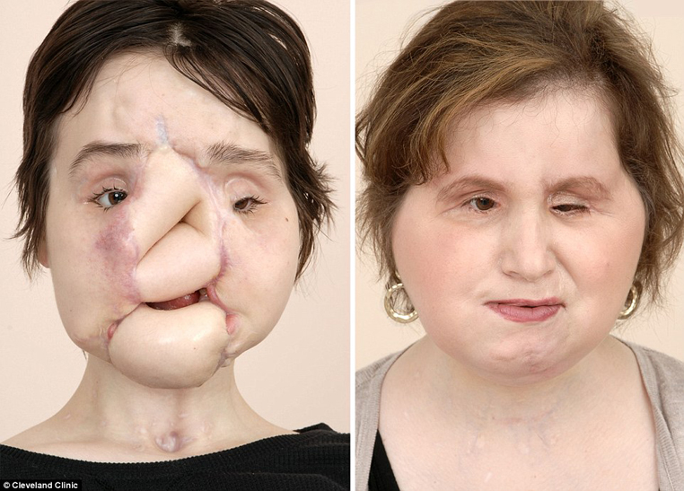 
Khuôn mặt của Katie trước và sau ca phẫu thuật.