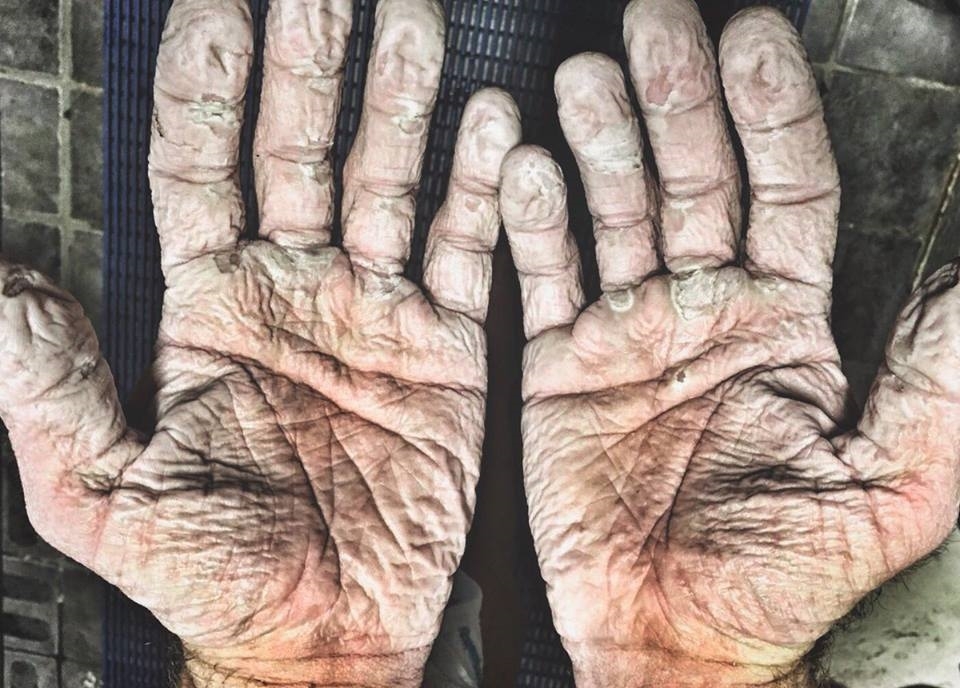 
Sau chuyến hành trình, bàn tay của Alex Gregory gần như biến dạng hoàn toàn do anh đeo găng tay chèo thuyền trong thời tiết lạnh giá và ẩm ướt.