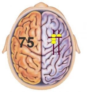 
Bán cầu não trái ghi nhớ số 75, bán cầu não phải ghi nhớ vị trí hạt trên bàn tính
 