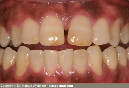 Mối liên kết mật thiết giữa răng miệng và các cơ quan nội tạng, chìa khóa giúp dự đoán sớm ung thư