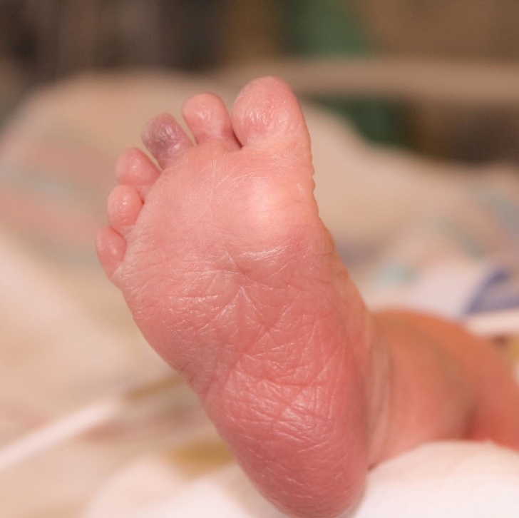 
Em bé này sinh ra với tổng cộng 12 ngón chân