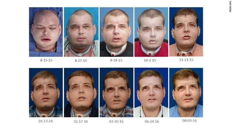 Người đàn ông mang khuôn mặt dị dạng suốt 14 năm trời, chịu hơn 70 ca phẫu thuật để được làm người