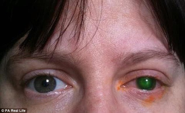 
Người phụ nữ đã mất hoàn toàn thị lực bên mắt trái do đeo kính áp tròng khi bơi