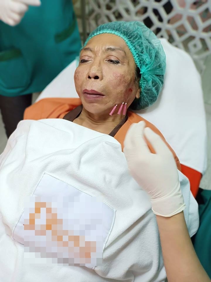 
Sitang Buathong quyết định đến spa để nhờ bác sĩ thẩm mỹ chữa những vết rỗ trên mặt mình