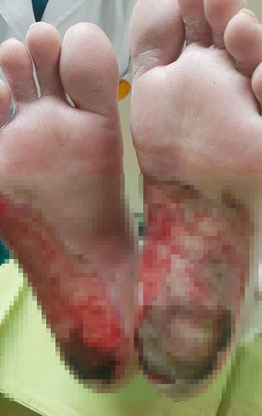 Góc Cảnh Giác: Hoại tử các ngón chân và lở loét do ngâm chân trong nước nóng