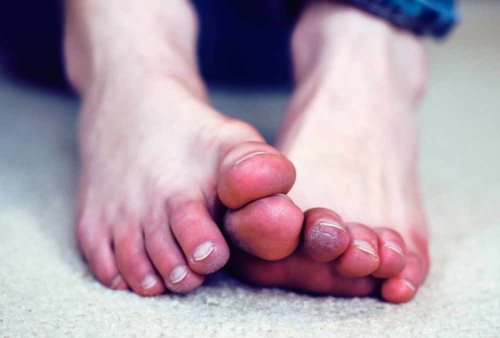 Góc Cảnh Giác: Hoại tử các ngón chân và lở loét do ngâm chân trong nước nóng