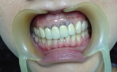 GÓC CẢNH GIÁC: Trào lưu bọc răng, phủ răng sứ và cạm bẫy phía sau những 
