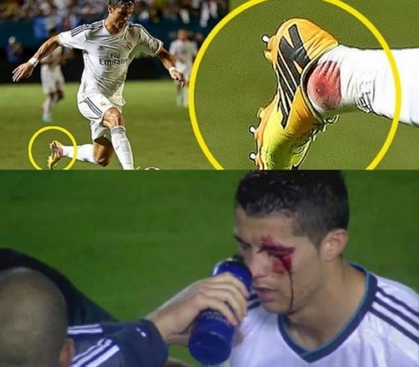 
Mùa hè vừa qua, trong trận đấu giao hữu với Chelsea, Cristiano Ronaldo của Real Madrid đã gặp phải chấn thương mắt cá chân khá nghiêm trọng.