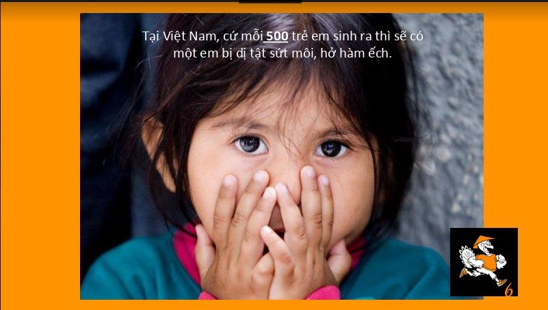 
Ở Việt Nam, cứ 500 trẻ em sinh ra thì sẽ có 1 bé bị mắc dị tật sứt môi, hở hàm ếch.
