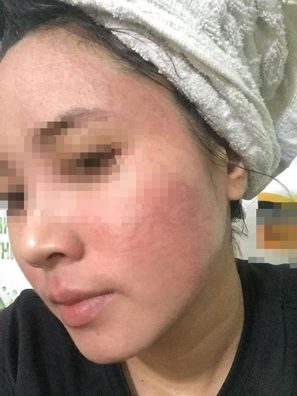 
Cô gái cầu cứu dân mạng vì gương mặt nổi mụn chi chít sau khi sử dụng sản phẩm rượu thuốc bắc - Ảnh: Internet