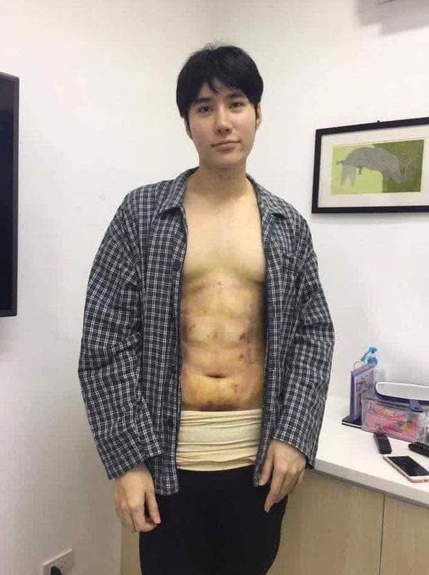
Một chàng trai quyết định phẫu thuật để có được cơ bụng trong mơ