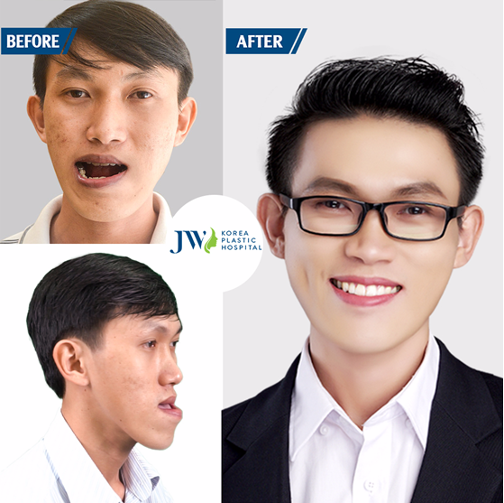 
Duy Phương trước và sau khi phẫu thuật hàm móm thành công. 