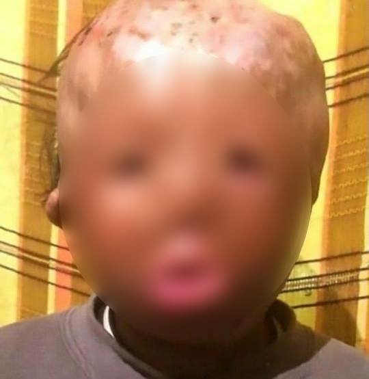 
Cậu bé 5 tuổi bị mất khuôn mặt trong một vụ hỏa hoạn khi em còn rất nhỏ 