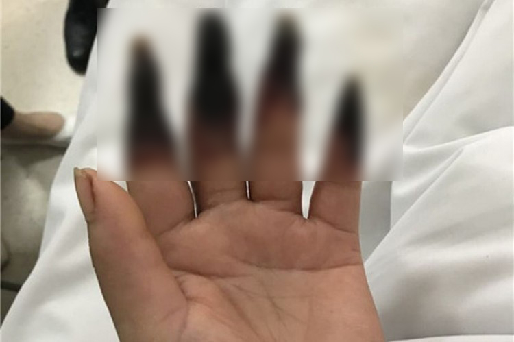 
Bàn tay người phụ nữ Trung Quốc biến thành màu đen sau 2 ngày chỉ vì một vết thương nhỏ 