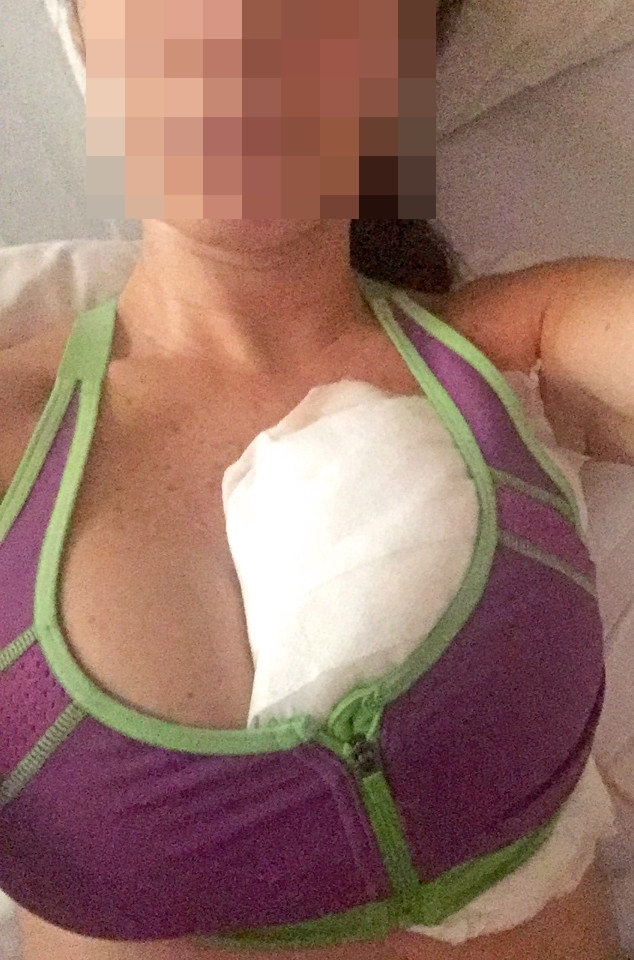 Góc Cảnh Giác: Người phụ nữ buộc phải cắt bỏ ngực trái vì phẫu thuật thẩm mỹ bị nhiễm trùng