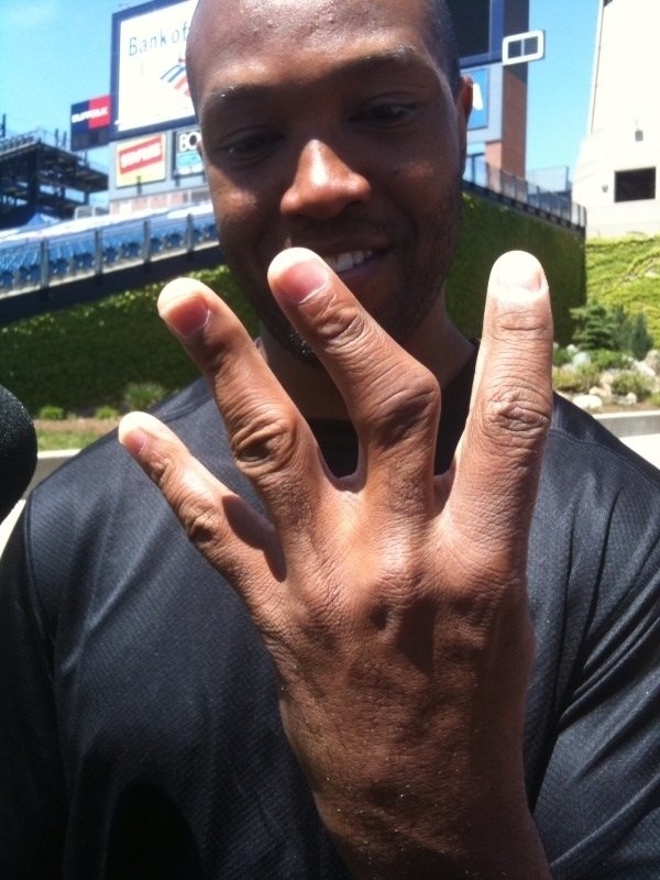 
Chơi bóng bầu dục quá lâu ở vị trí bắt bóng, những ngón tay của cầu thủ người Mỹ Torry Holt bị vẹo qua một bên trông khá dị dạng.