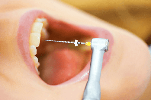 
Tiếng khoan răng thực sự khiến nhiều người ghê sợ. 