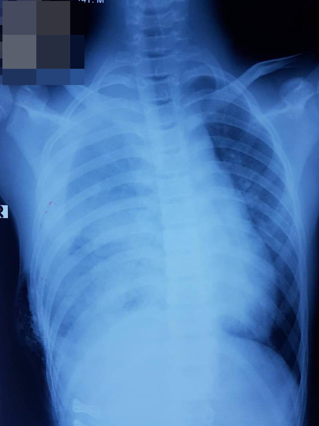 
Kết quả xét nghiệm bằng hình ảnh học cho thấy bé bị xẹp một bên phổi.