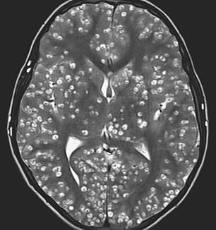 
Rất nhiều các chấm trắng, được cho là nang sán xuất hiện trong vỏ não của nam thanh niên 