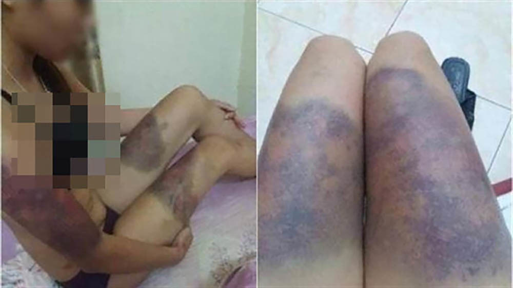  
Nạn nhân bị nhóm người đánh tới sảy thai và thâm tím đầy người (Ảnh: Vietnamnet)