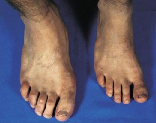  
Nhiều bộ phận cơ thể sưng to và phát triển bất thường (trái) là biểu hiện của căn bệnh này.