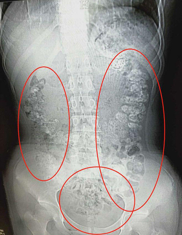  
Ảnh chụp cắt lớp ổ bụng của bệnh nhân, nó chứa đầy hạt