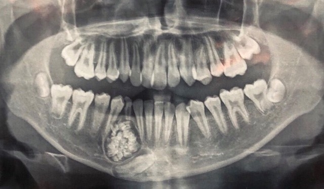  
Hình chụp X-Quang của bệnh nhi.