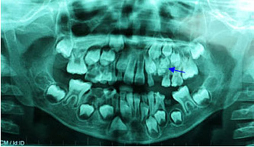  
U răng thường chỉ được nhìn thấy qua ảnh chụp X-Quang.
