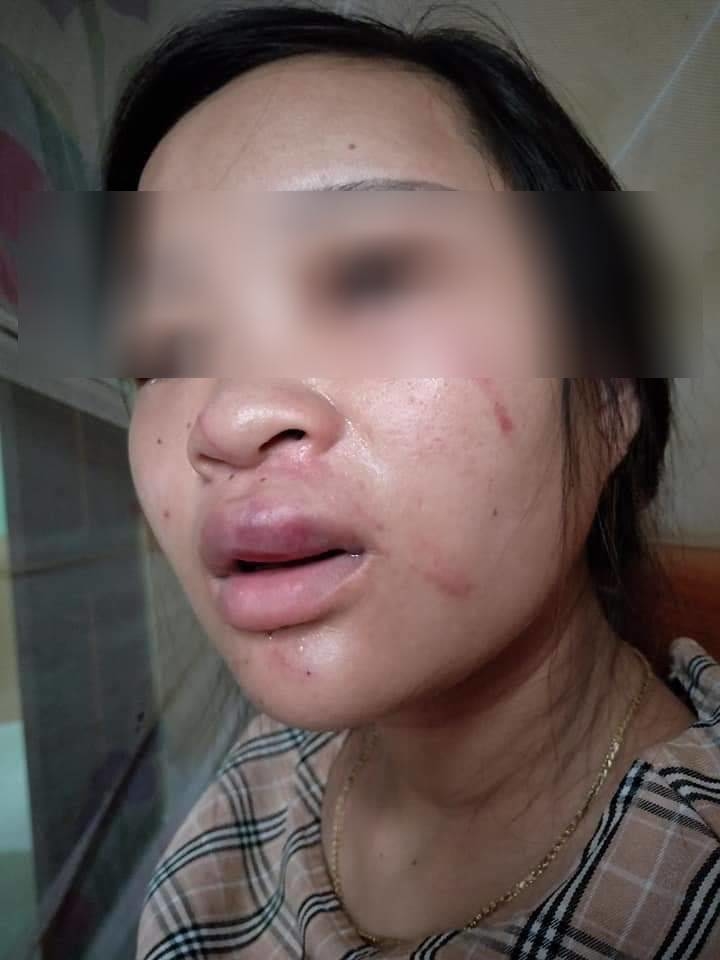  
Bà bầu bị đánh bầm dập cả mặt mũi.