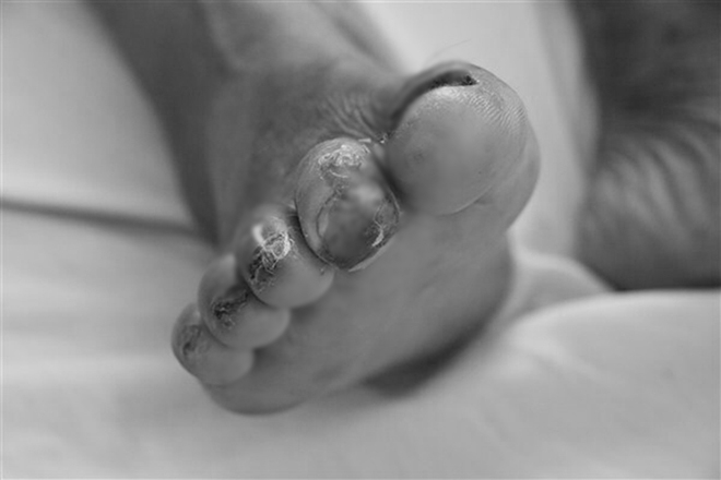  
Chân của một bệnh nhân bị nhiễm Whitmore