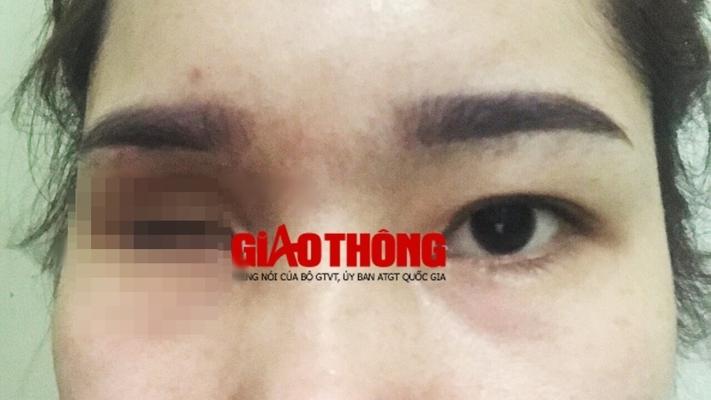 Mắt phải của L. theo như chẩn đoán của bác sĩ ở Khoa Mắt của bệnh viện Bạch Mai thì đã mất thị lực hoàn toàn (Ảnh: Báo Giao Thông)