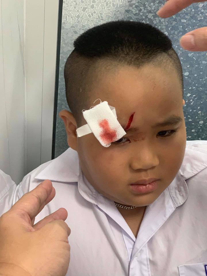  
Vết thương trên mặt của con trai nam diễn viên Hiếu Hiền - Tin sao Viet - Tin tuc sao Viet - Scandal sao Viet - Tin tuc cua Sao - Tin cua Sao