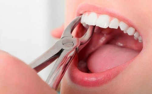  
Việc có nhổ răng trước khi niềng hay không sẽ tùy thuộc vào tình trạng hàm răng của bạn như thế nào nữa nhé! (Ảnh: FB)