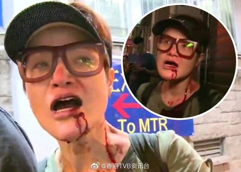 Nữ diễn viên nổi tiếng TVB bị đánh trọng thương trên phố