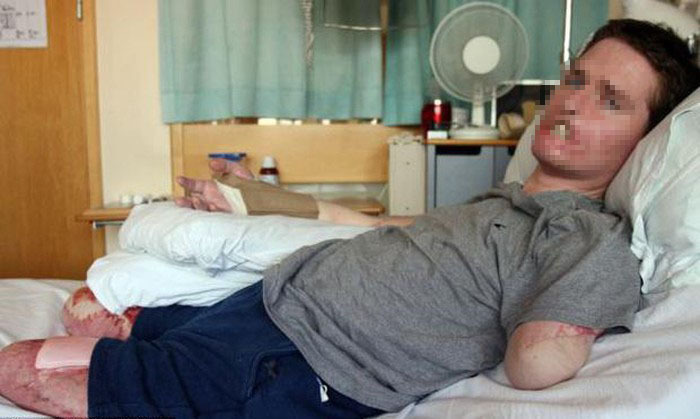  
Tỉnh dậy trong bệnh viện, người đàn ông này ngỡ ngàng vì mất tay chân và môi.