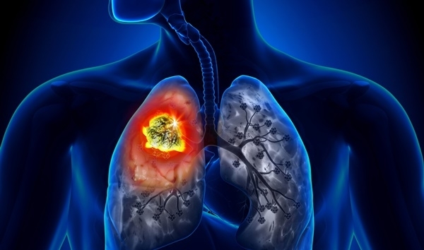  
Không riêng khói thuốc, nhiều nguyên nhân khác cũng có thể dẫn đến bệnh ung thư phổi.