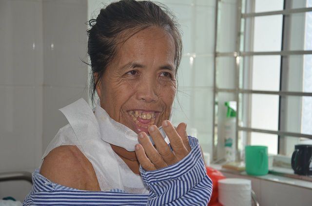 
Ca phẫu thuật do PGS. TS Vũ Quang Vinh thực hiện, đã tái tạo lại khuôn mặt cho chị Sáu.