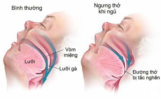  
Chứng ngưng thở khi ngủ cũng là tác nhân gây ra việc nước dãi sẽ "tuôn trào" mạnh mẽ ra khỏi khoang miệng của mỗi người khi ngủ. (Ảnh: doctors24h)