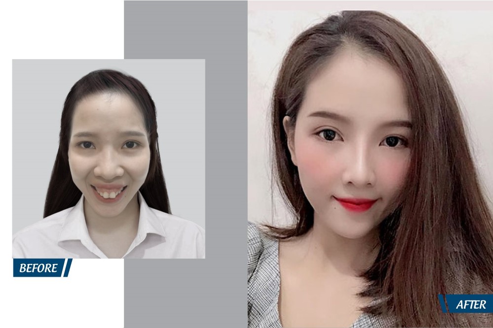  
 Cô gái 9X xinh đẹp chỉ nhờ 1 lần can thiệp phẫu thuật hàm hô tại Bệnh viện JW Hàn Quốc