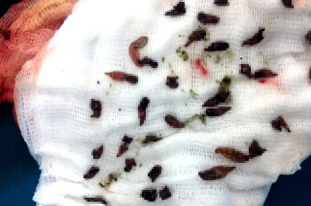  
Hình ảnh những con sán được gắp ra từ trong túi mật của một bệnh nhân. (Ảnh minh họa: tinmoi)