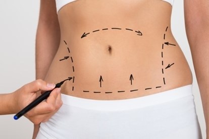  
Người càng béo thì càng có nguy cơ gặp biến chứng khi hút mỡ bụng (Ảnh minh họa: Lao Động)