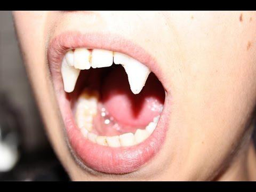  
Hàm răng đáng sợ thực chất lại là vì bong tróc nướu mà ra. (Ảnh minh họa: Pinterest)