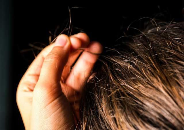  
Hội chứng bứt tóc và thích ăn tóc rất hiếm gặp trên thế giới. (Ảnh: Instagram)