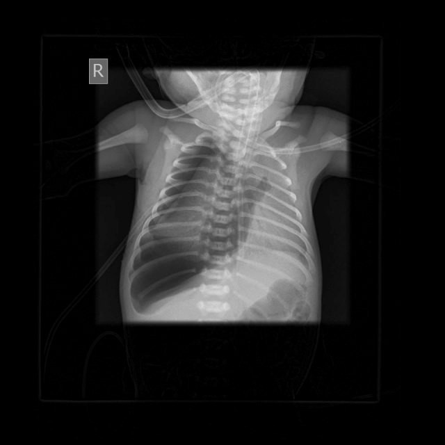  
Ảnh chụp X-quang cho thấy nang phổi phải có dấu hiệu bất thường (Ảnh: Dân Trí)