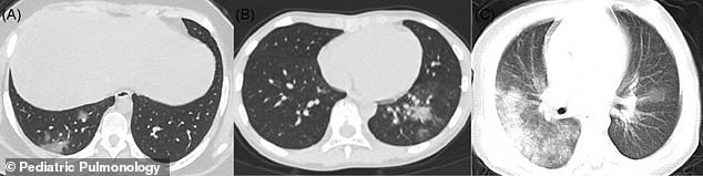  
Hình ảnh cho thấy phổi của trẻ nhiễm Covid-19 bị sưng và quầng sáng mờ (Halo sign) bao phủ. Ảnh: Pediatric Pulmonology