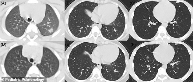  
Hàng trên là hình ảnh phổi của trẻ em bị nhiễm bệnh và tương ứng phía dưới là tình trạng phổi sau khi hồi phục. Ảnh: Pediatric Pulmonology