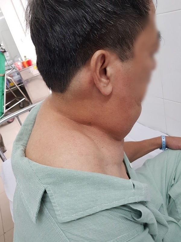  
Bệnh nhân nam tại Hà Nội đã nghiện rượu tới 40 năm. (Ảnh: Bệnh viện Ung bướu)